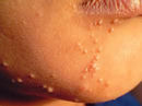 Molluscum Contagiosum on the face